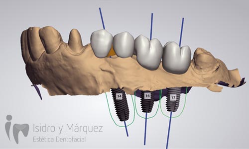 cirugía guiada - Isidro y Márquez Estética Dentofacial